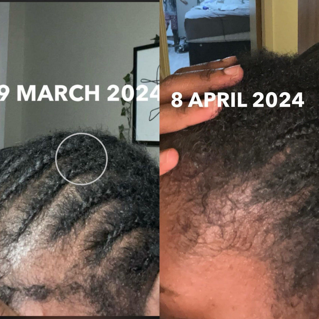 A customer's own photographs of a bare patch at the hairline, 4 weeks apart